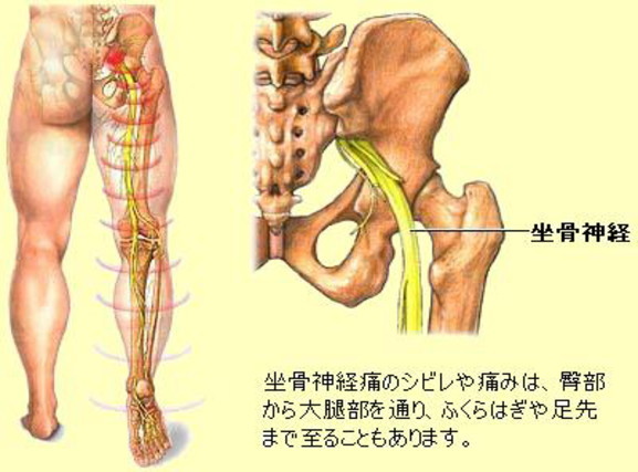 坐骨神経痛 龍観堂 大仙市 整体 腰痛 肩こり 骨盤矯正 マッサージ 偏頭痛